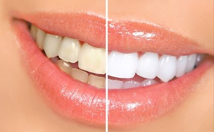 Teeth Whitening (Bleaching)