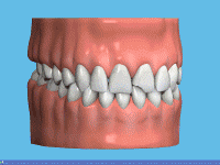 Diş Çürüğü Tedavisi