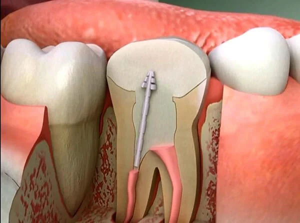 Root Canal Treatment
