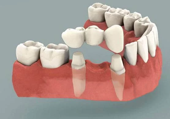 Fixed Dentures